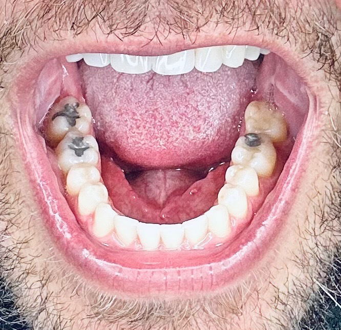 Bigoleteeth14