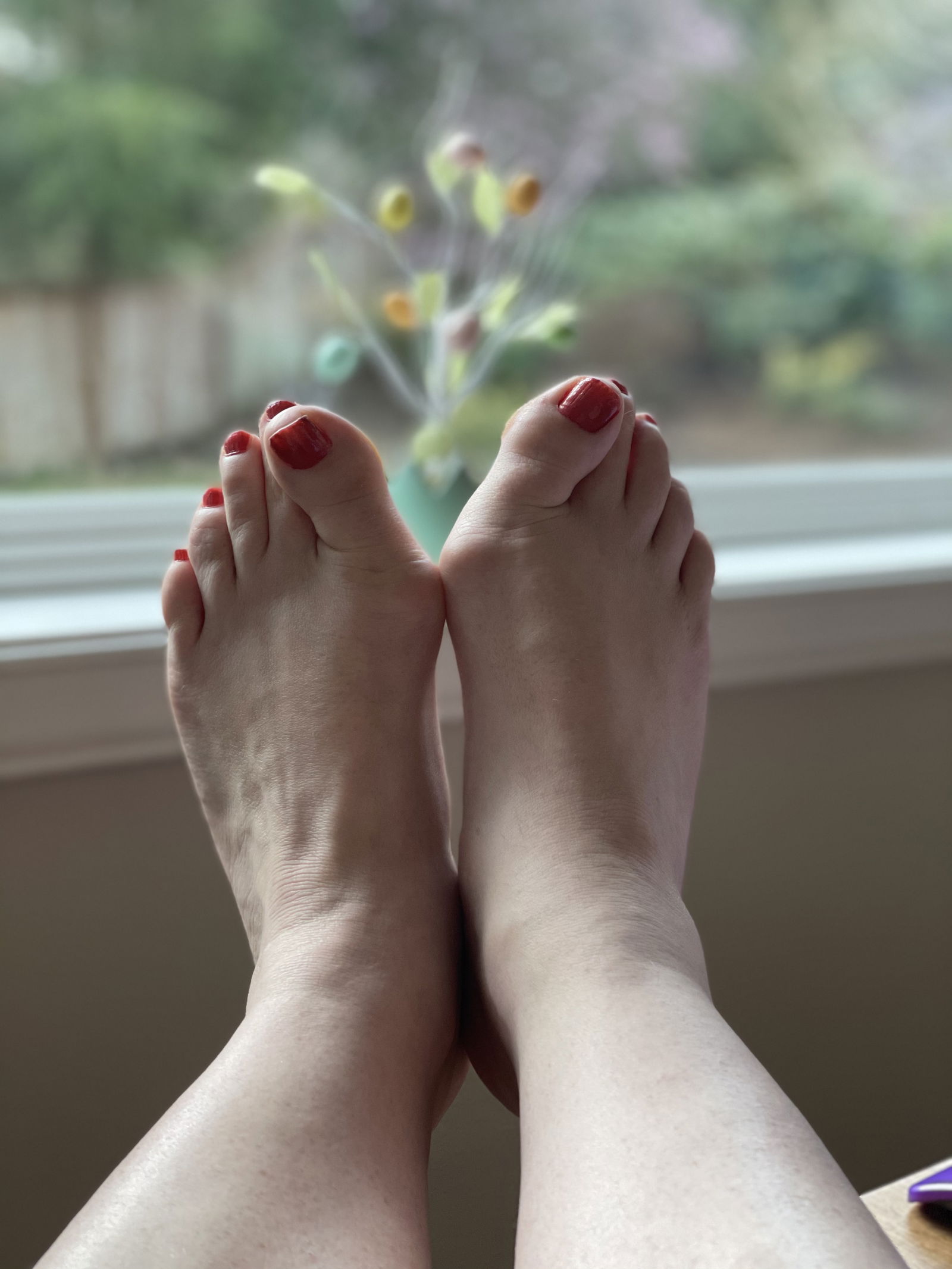 Marissa Bunions