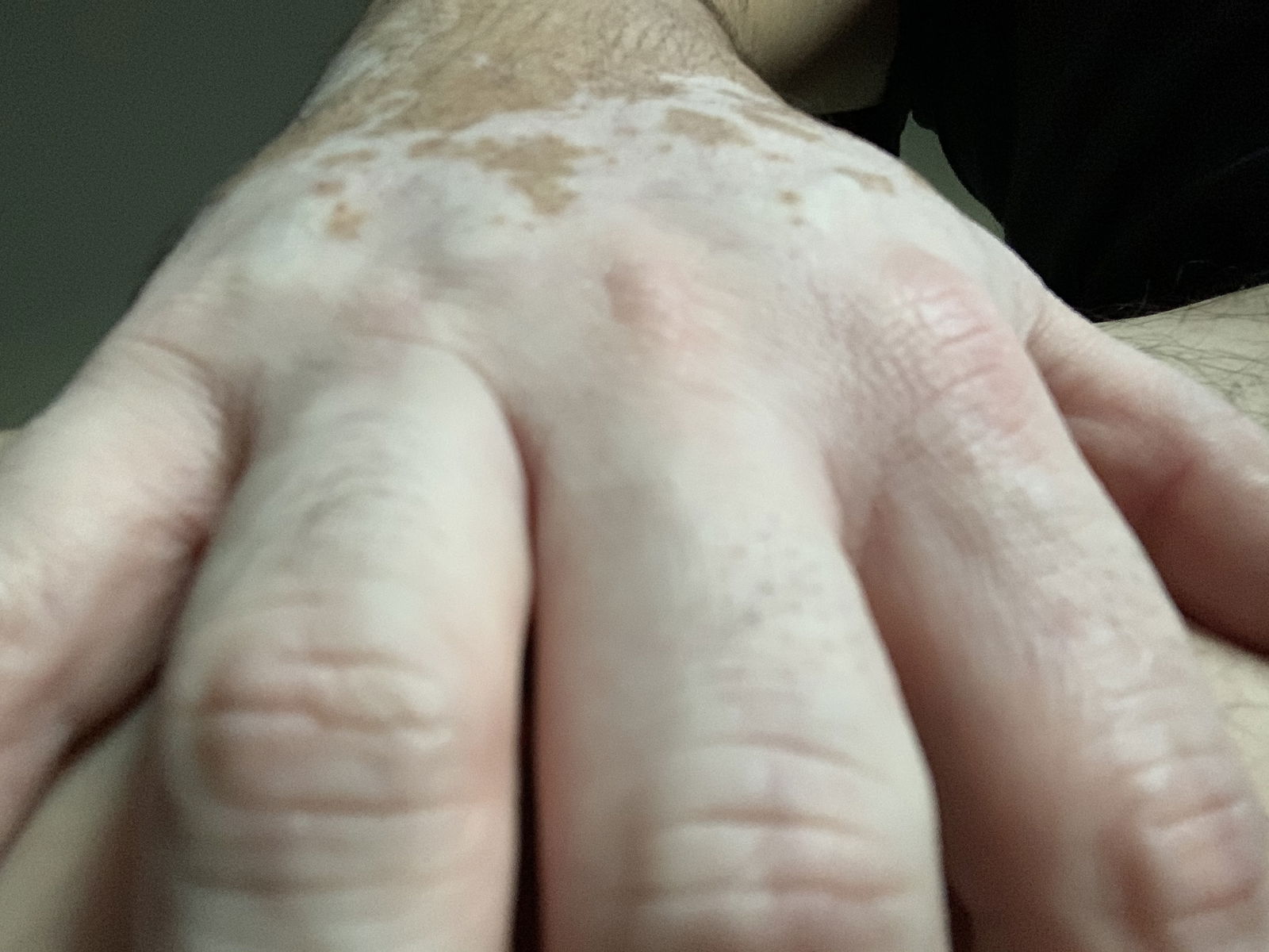 Vitiligo Body Exposed profile banner