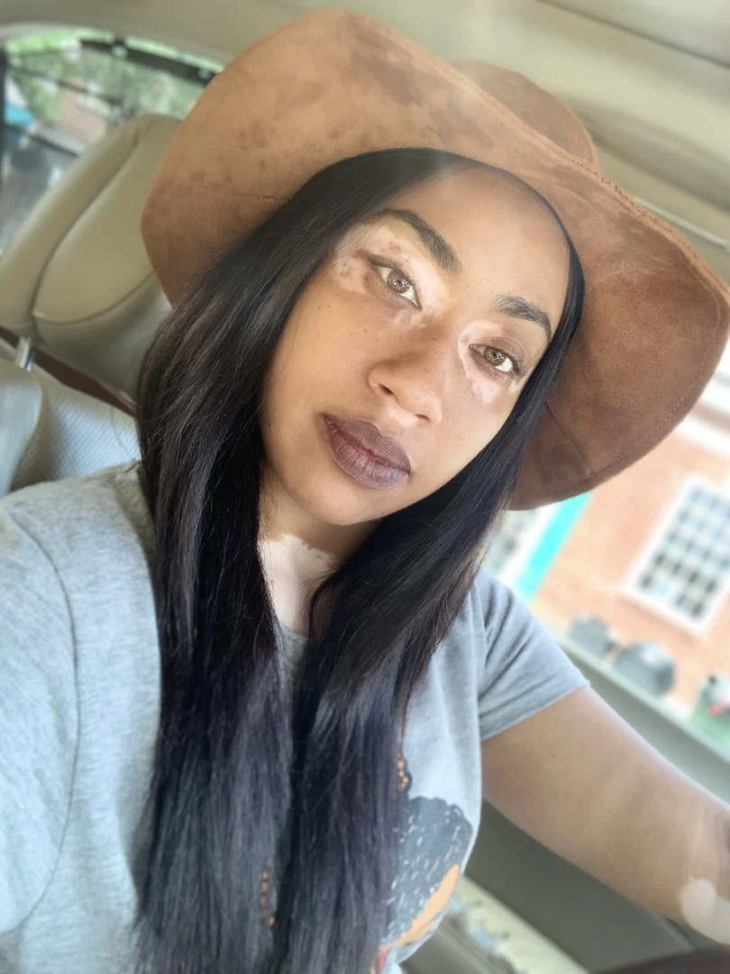 Vitiligo Fox profile banner