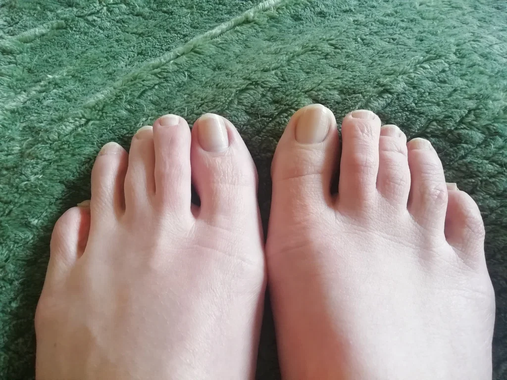 Unsexy Toes