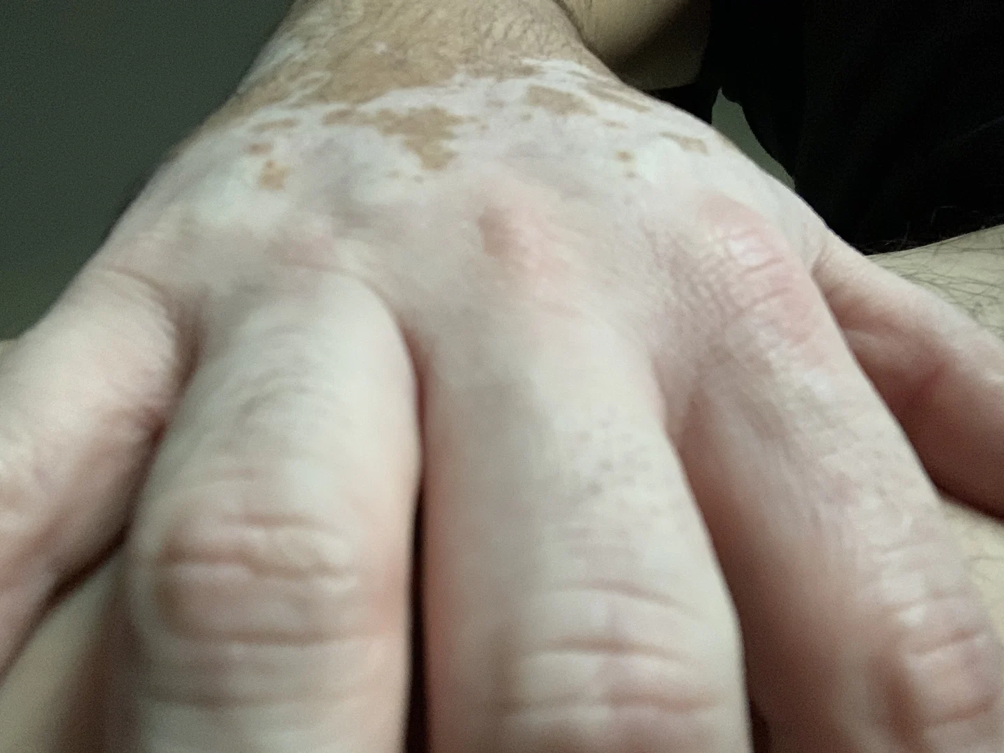 Vitiligo Body Exposed profile banner