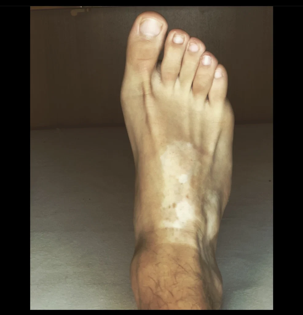 Vitiligo feets's avatar